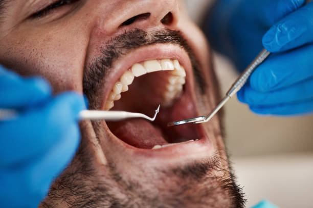 Best Emergency Dentist for Lost Fillings or Crowns in West Crossett, AR